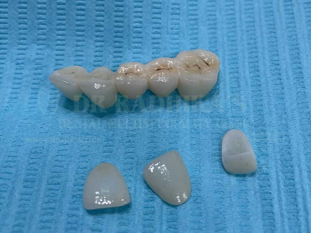 3M-Full-mouth-case-10-1