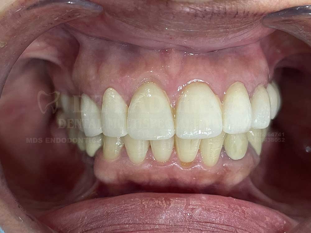 3M-Full-mouth-case-10-3