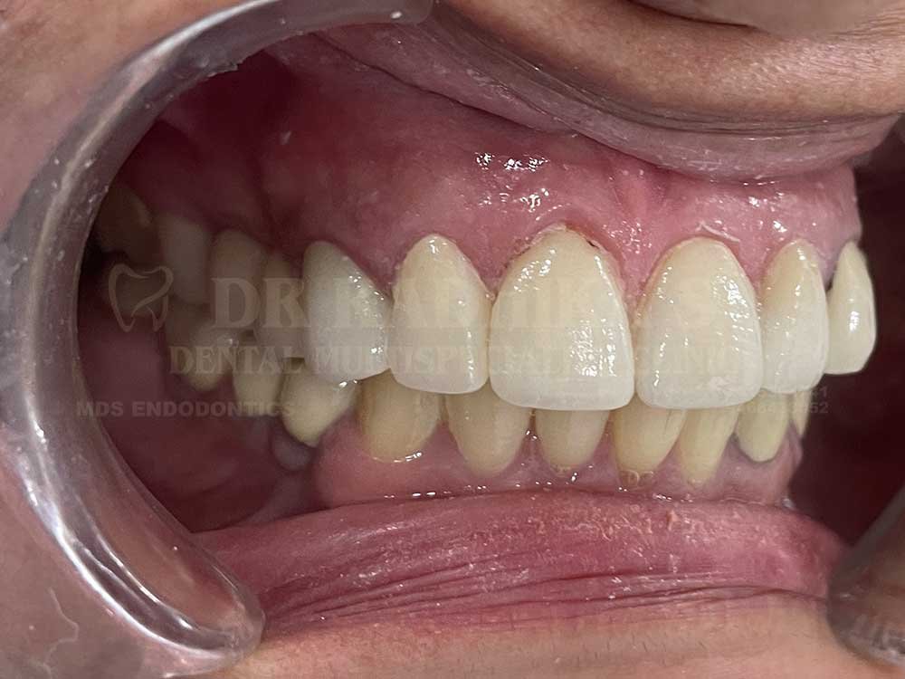 3M-Full-mouth-case-10-4