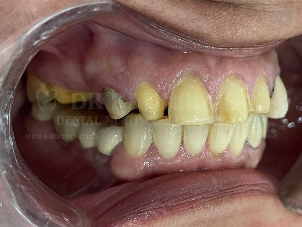 3M-Full-mouth-case-10-5