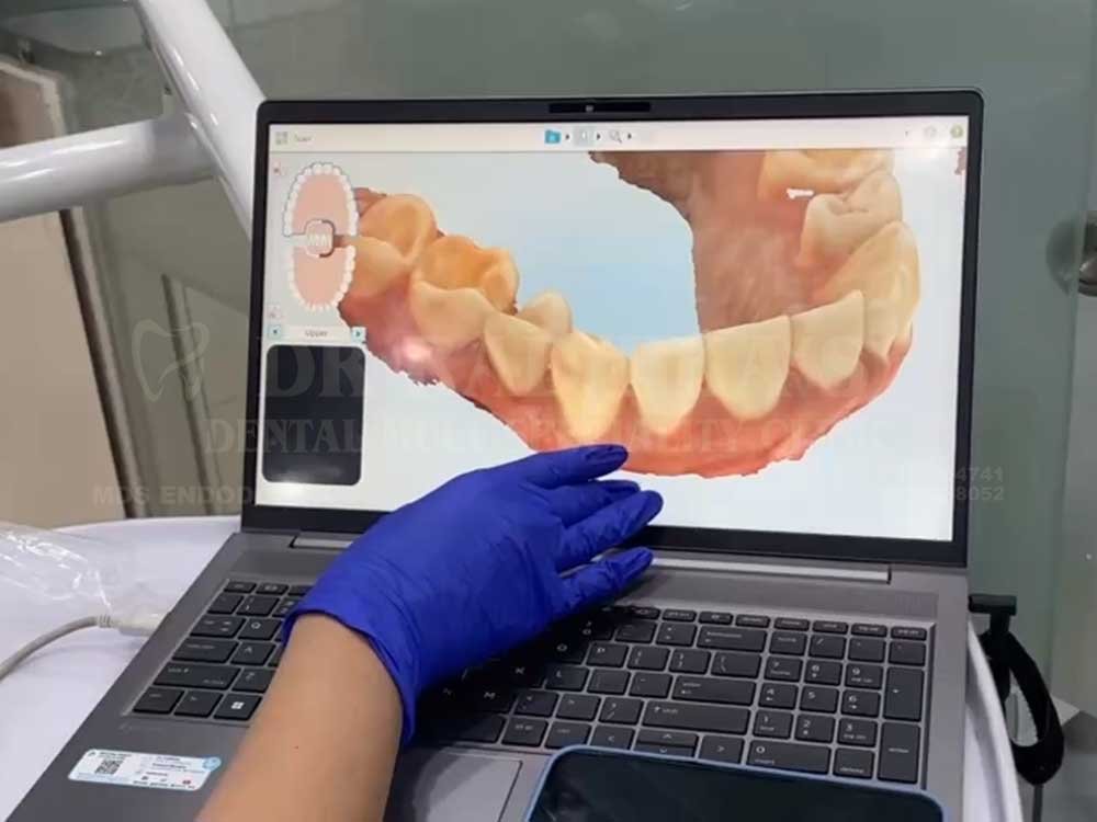 Clear-Aligners-Invisalign-4