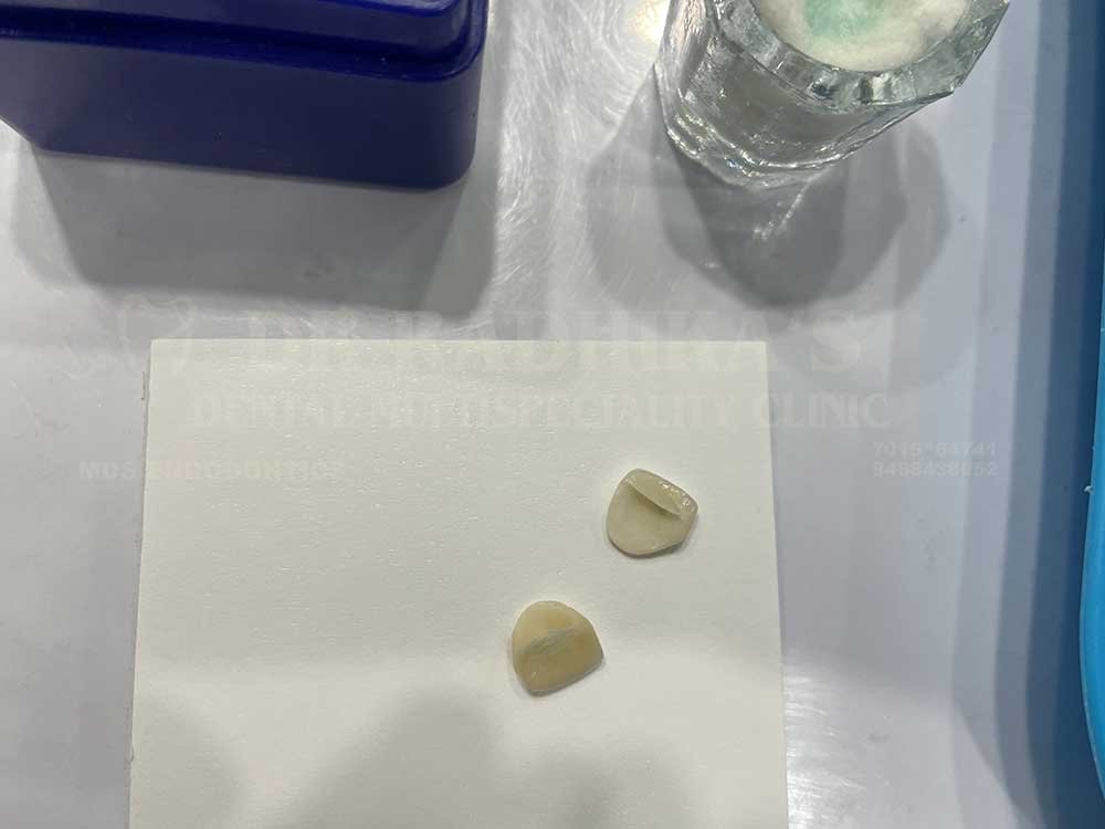 Crown-and-veneer-anterior-case-15-2