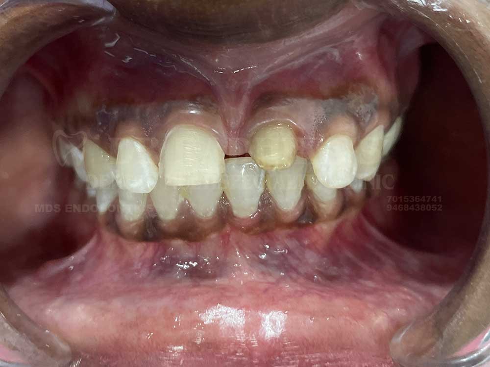 Crown-and-veneer-anterior-case-15-3