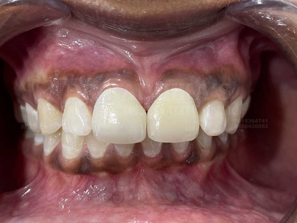 Crown-and-veneer-anterior-case-15-4