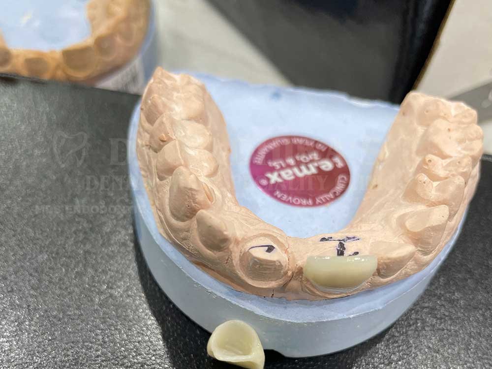 Crown-and-veneer-anterior-case-15-5