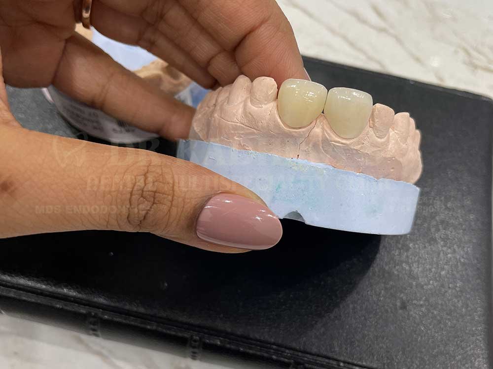 Crown-and-veneer-anterior-case-15-6