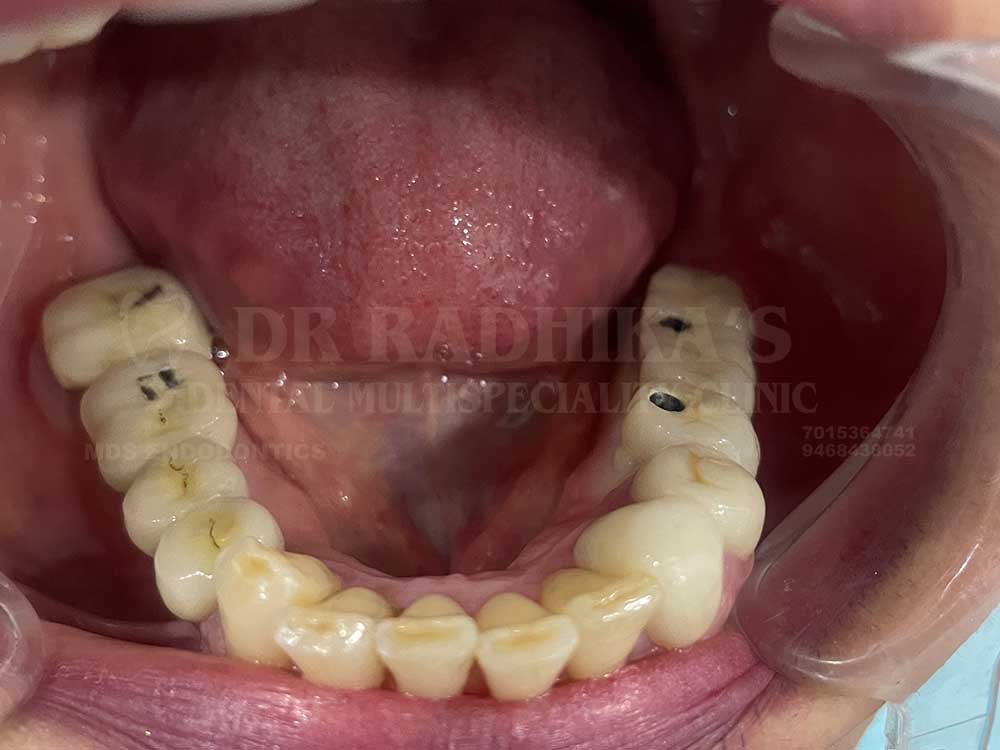 Implant-case-3-after-1