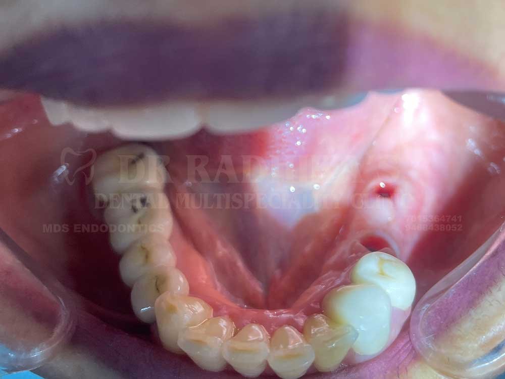 Implant-case-3-bef-1