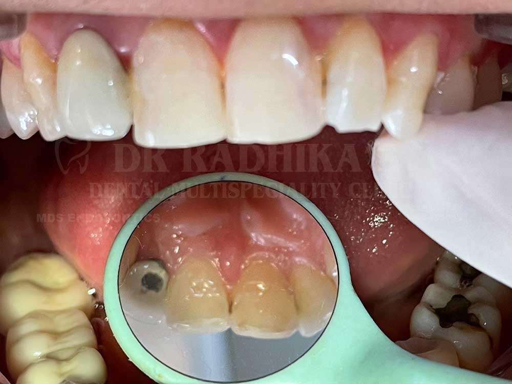 Tooth-coloured-restoration-1-1