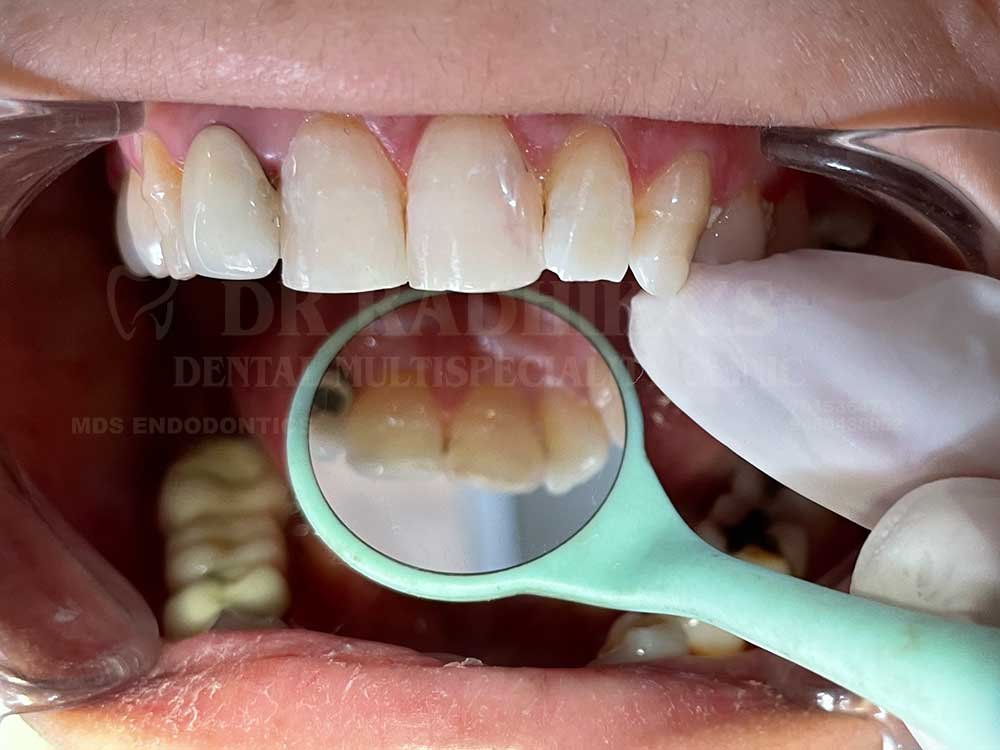 Tooth-coloured-restoration-1-2