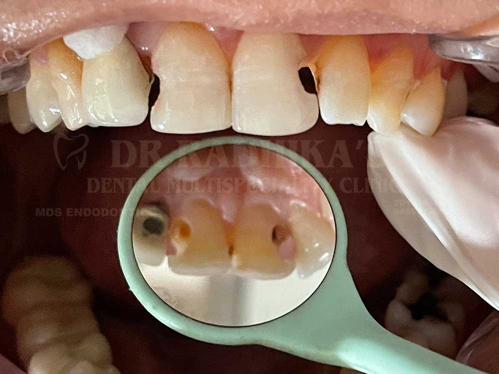 Tooth-coloured-restoration-1-3