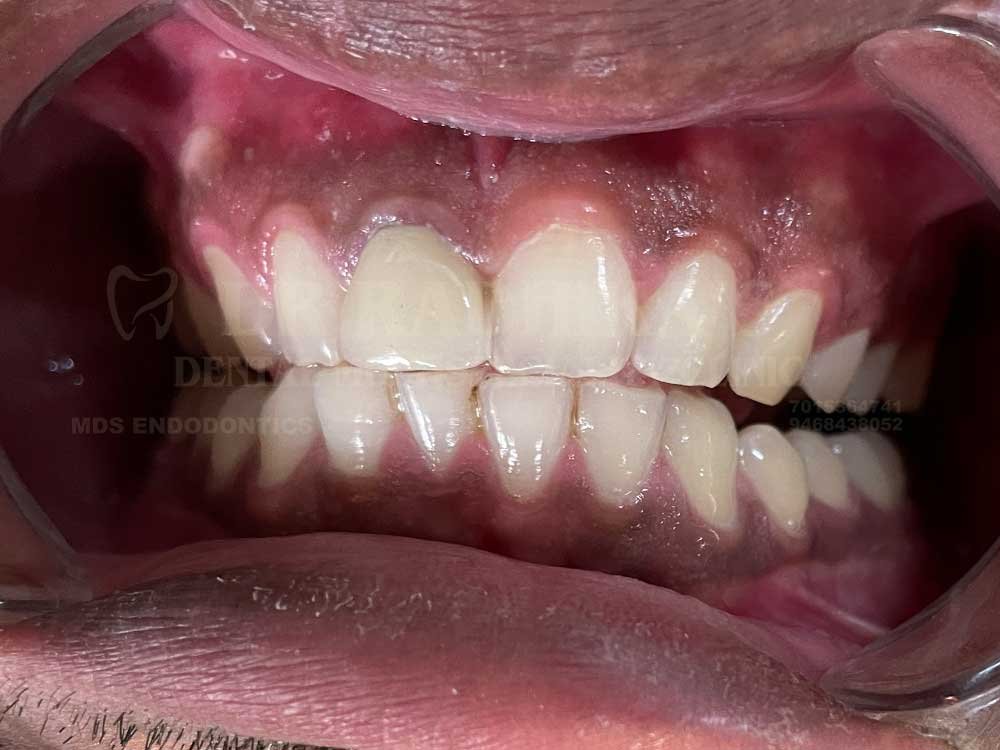 Tooth-coloured-restoration-2-1