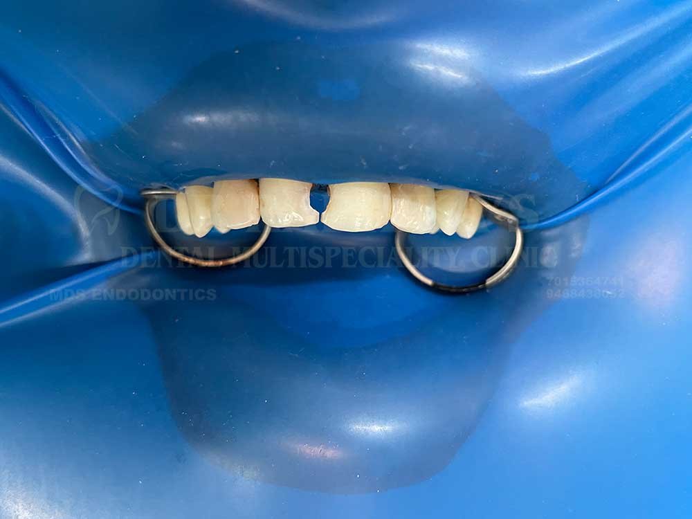 Tooth-coloured-restoration-2-3