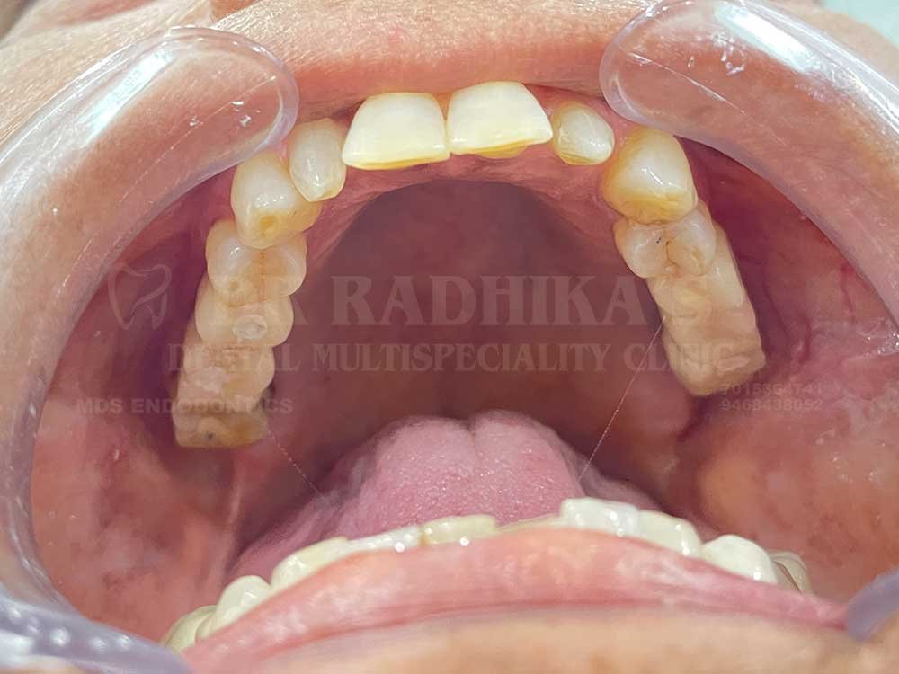 Upper-implants-case-1