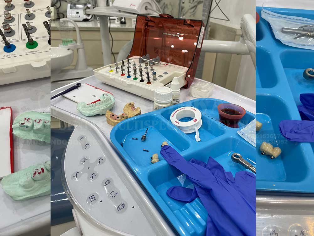 Upper-implants-case-4